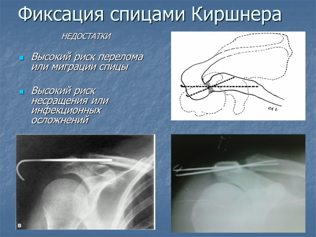 Фиксация спицами Киршнера НЕДОСТАТКИ Высокий риск перелома или миграции спицы Высокий риск несращения или